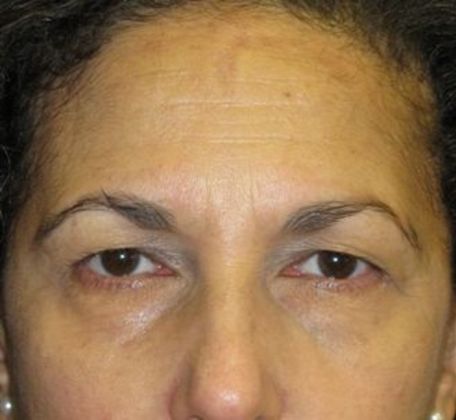 Before Brow Lift